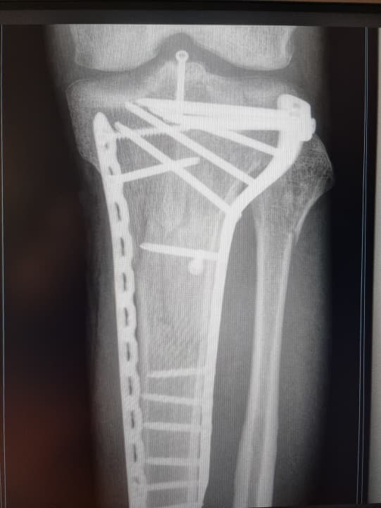 Scheenbeenbreuk in de knie door BIKE-redacteur Jan Timmermann. Toen het gewricht in de val werd verdraaid, werden ook ligamenten en menisci aangetast.